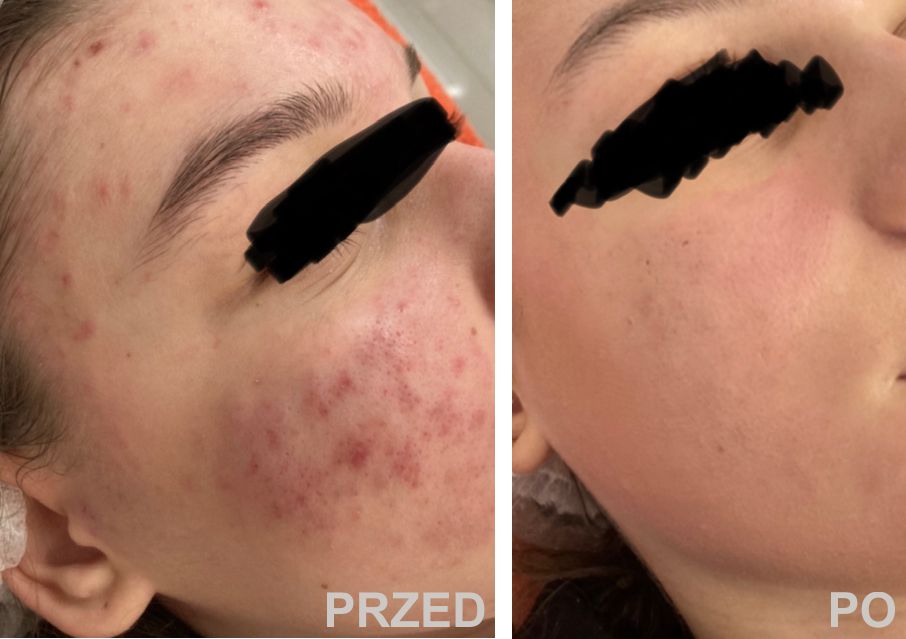 peeling stargard